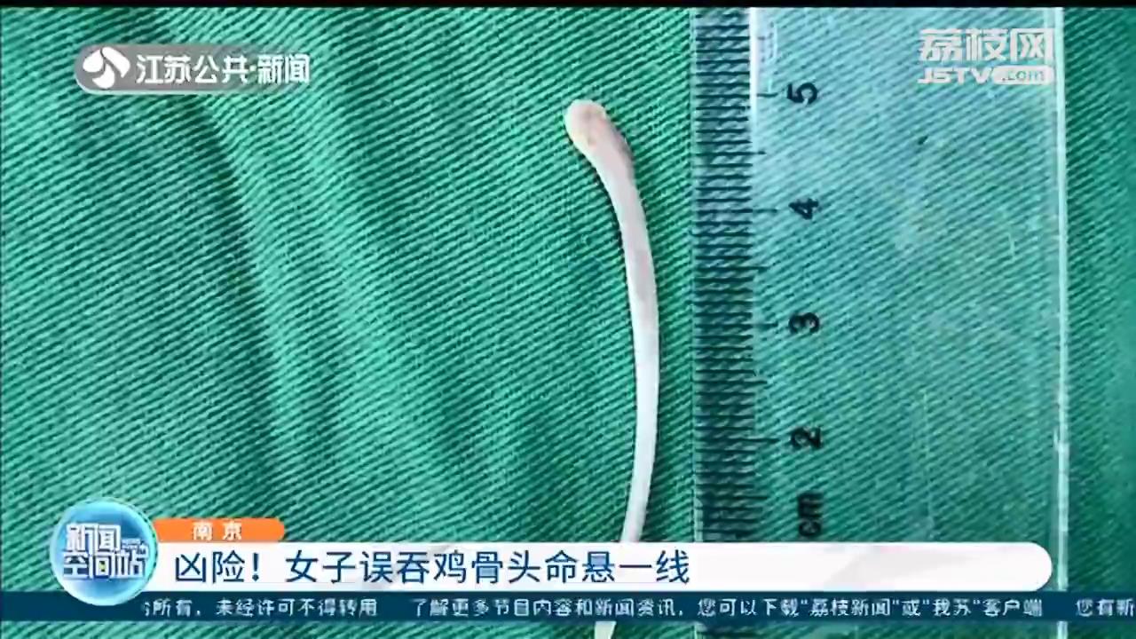 南京女子误吞鸡骨头命悬一线：以为是平常胃痛，休息就会好的