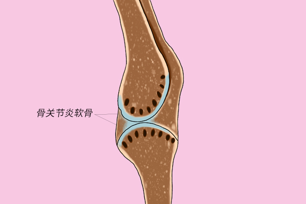 膝盖总是咔咔响，是怎么回事？要治疗吗？医生：这种情况不必担心