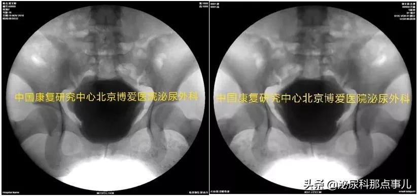 肠道膀胱扩大典型病例解析 | 神经源性下尿路功能障碍专栏 027