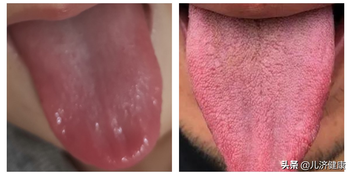 口腔溃疡成因有2种，对症调理才能见效快