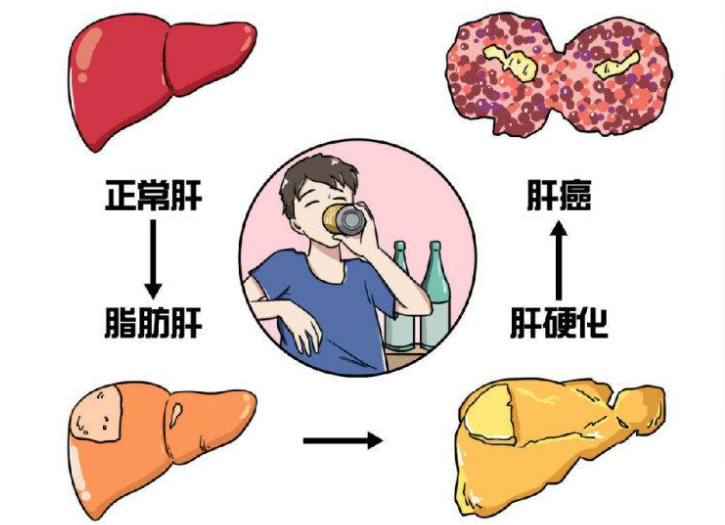 检查肝脏，选B超好还是CT好？哪个结果更准？肝病医生告诉你