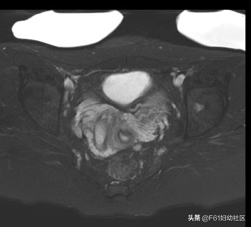 阴道斜隔及图片