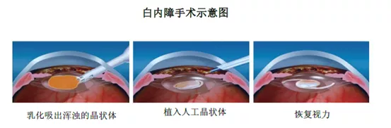 治疗白内障的爱博诺德IPO：市场受强生博士伦等巨头挤压