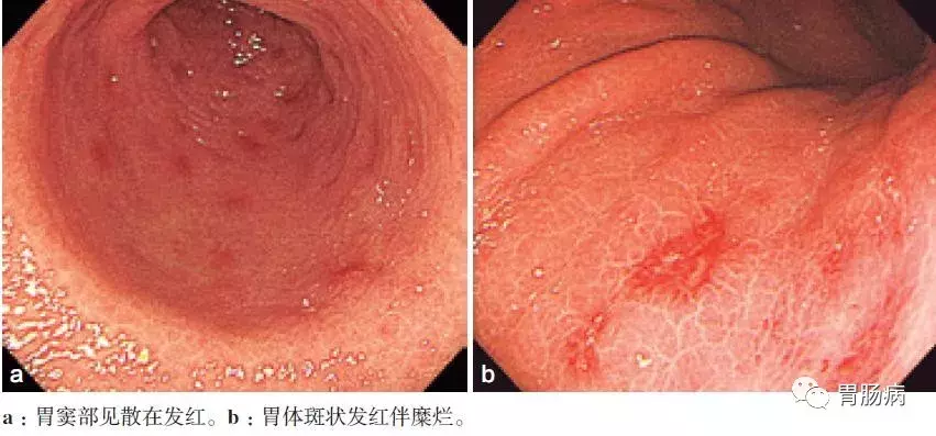 慢性浅表性（非萎缩性）胃炎