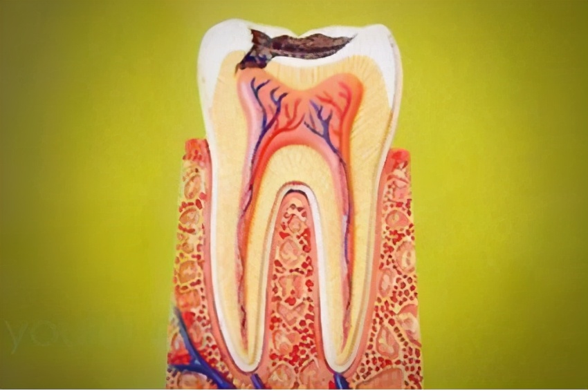 牙神经坏死的图片(蛀牙) - 赤虎壹号