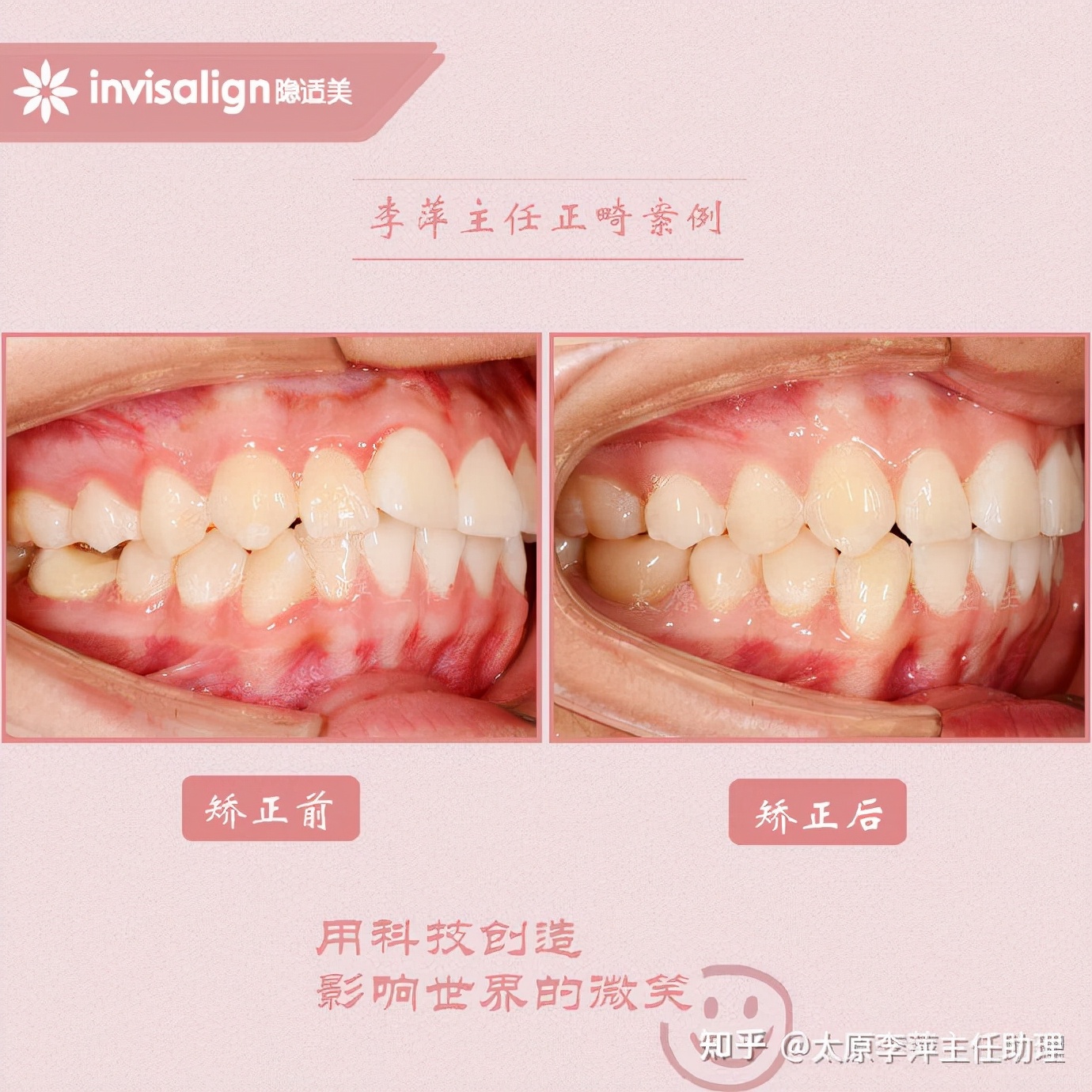 太原牙齿矫正：隐形牙套效果好不好？看这些病例你就知道了