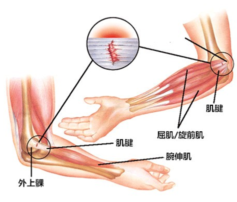 胳膊疼痛咋回事？