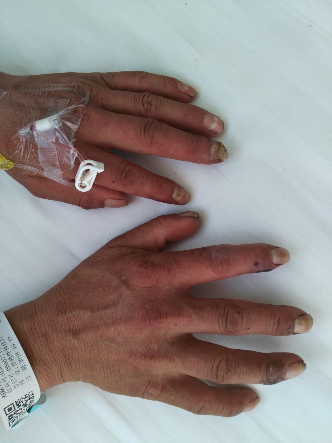 血栓闭塞性脉管炎又叫buerger病,简称为脉管炎,是非动脉粥样硬化性