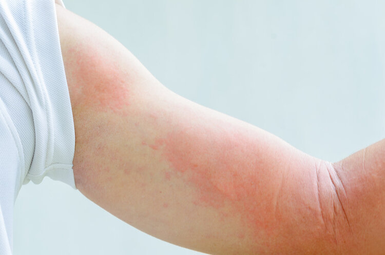荨麻疹让人瘙痒难耐，通过这4个小妙招，能减轻痛苦