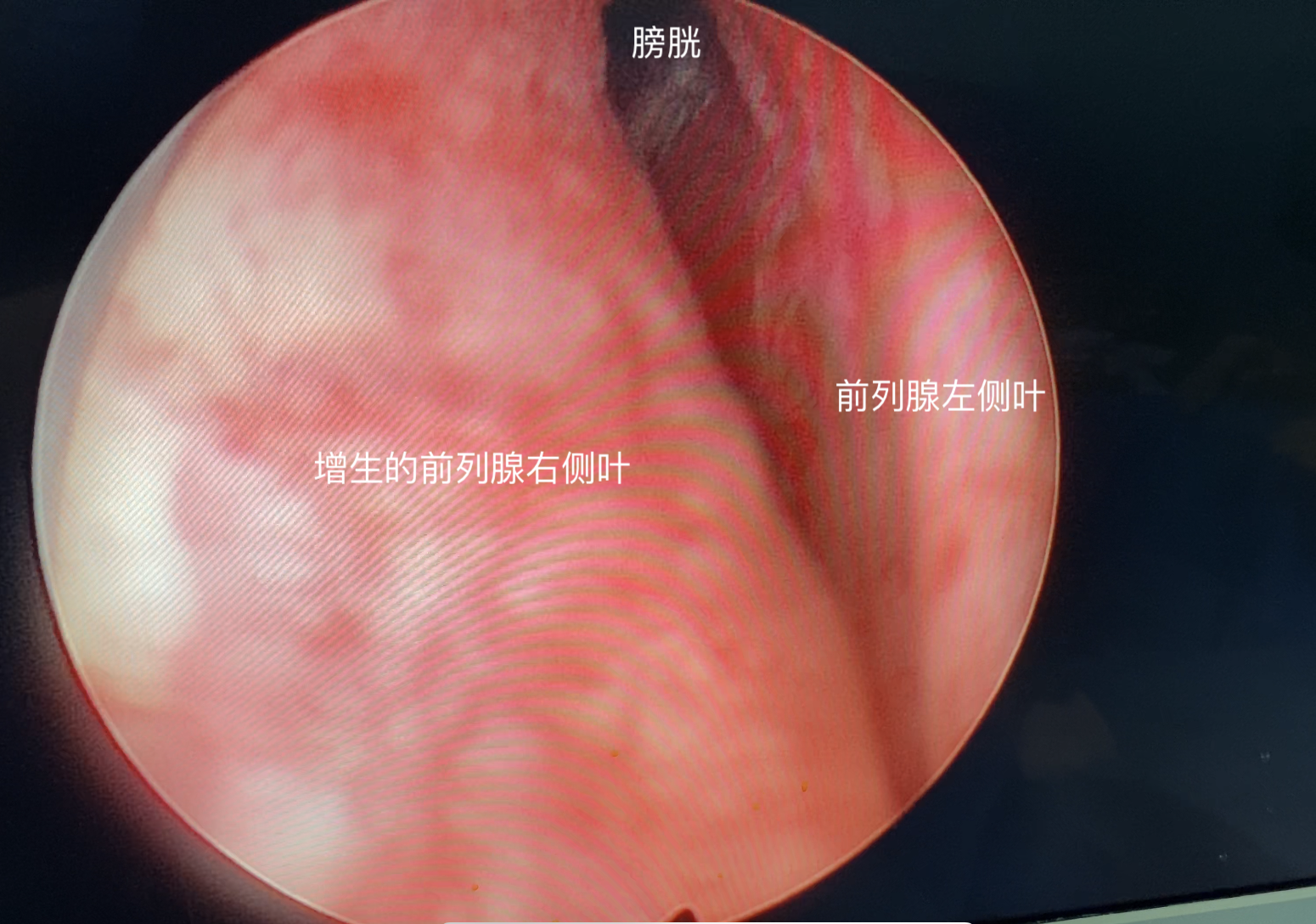 前列腺增生不能根治，那这个手术做了有什么用？为啥还要做手术？