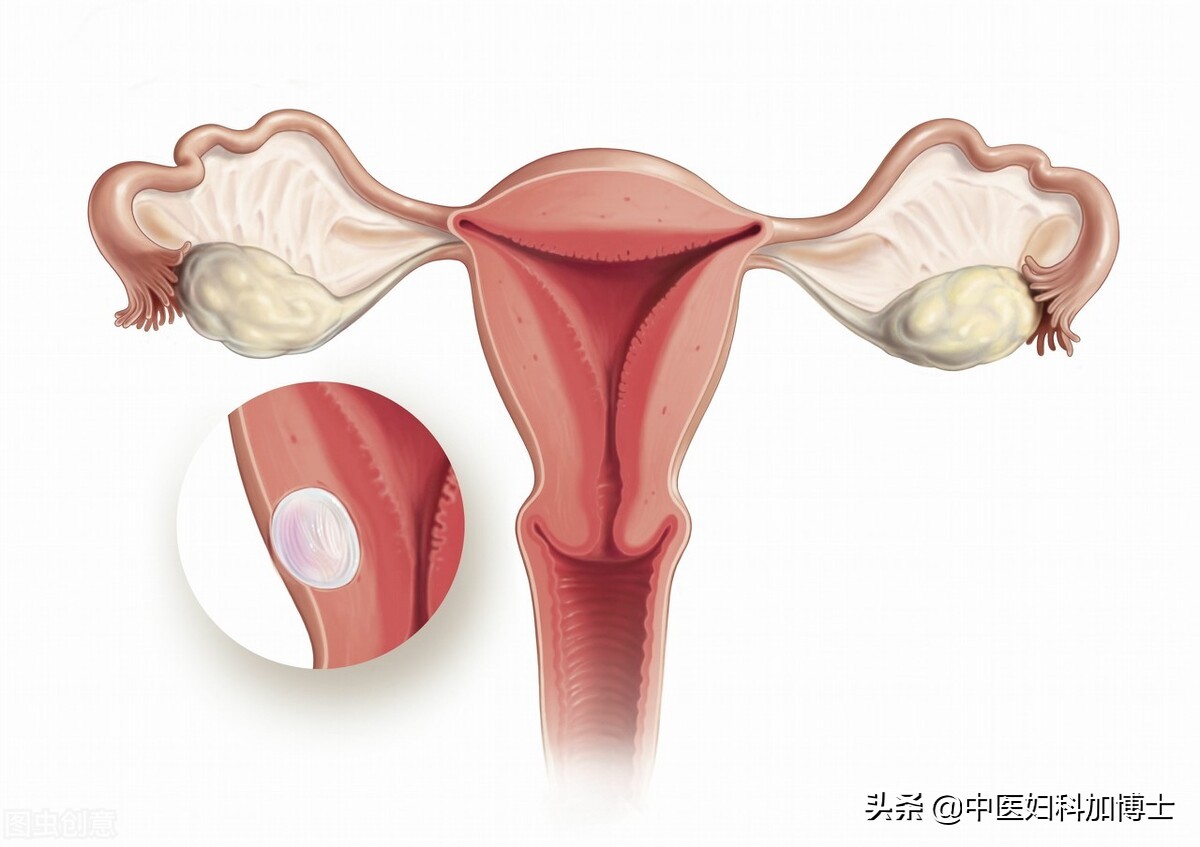 子宮切除後又長出了7.4cm的卵巢囊腫,到底是為什麼?