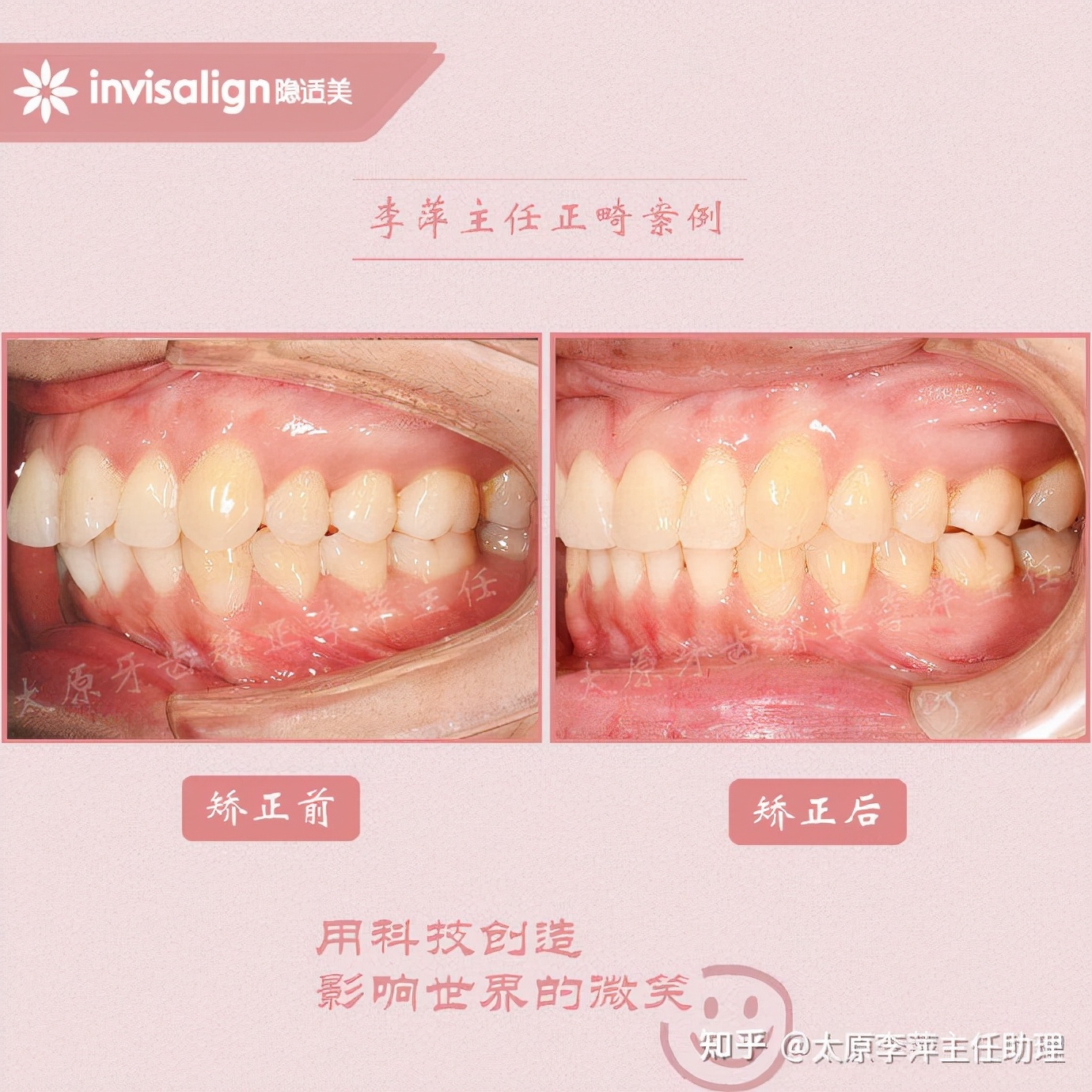 太原牙齿矫正：隐形牙套效果好不好？看这些病例你就知道了
