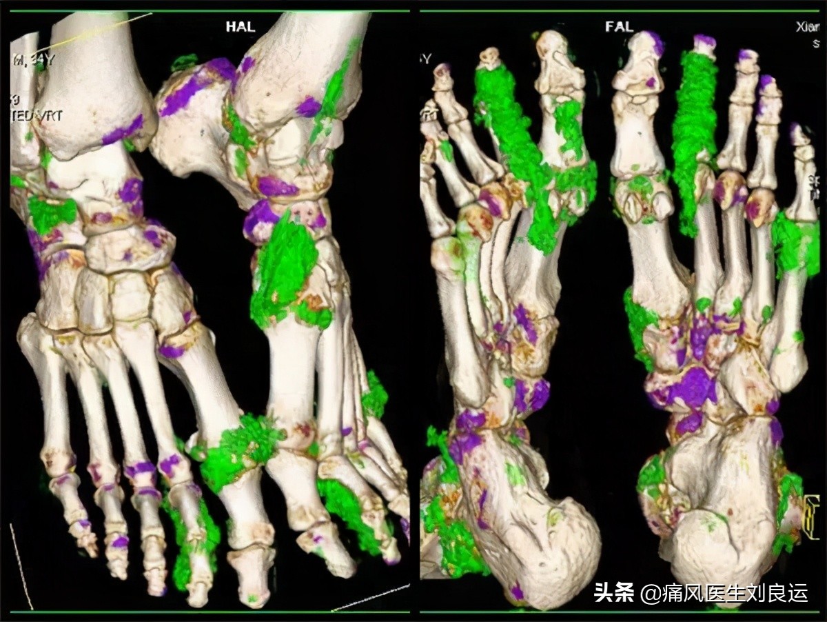 男子痛风后病急乱投医被误诊为腱鞘炎，不规范治疗双手长出痛风石