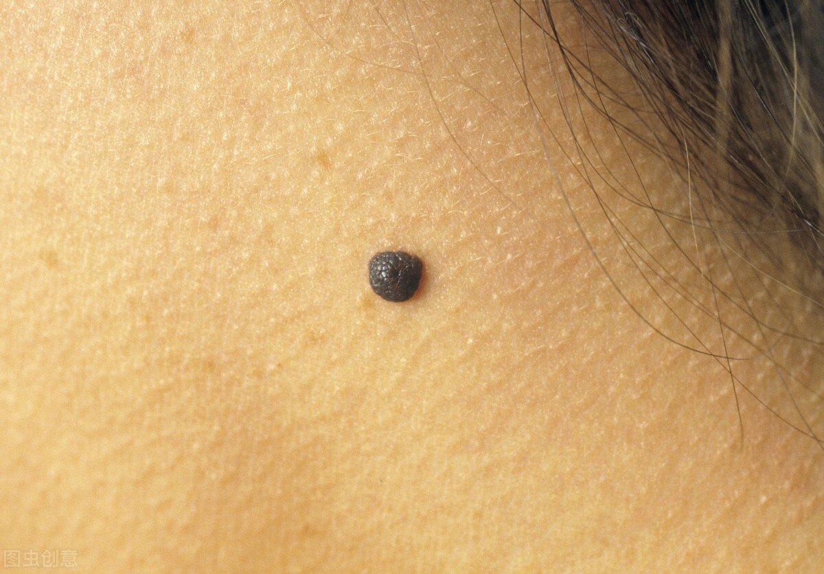 普通的一颗痣一颗痣的痣