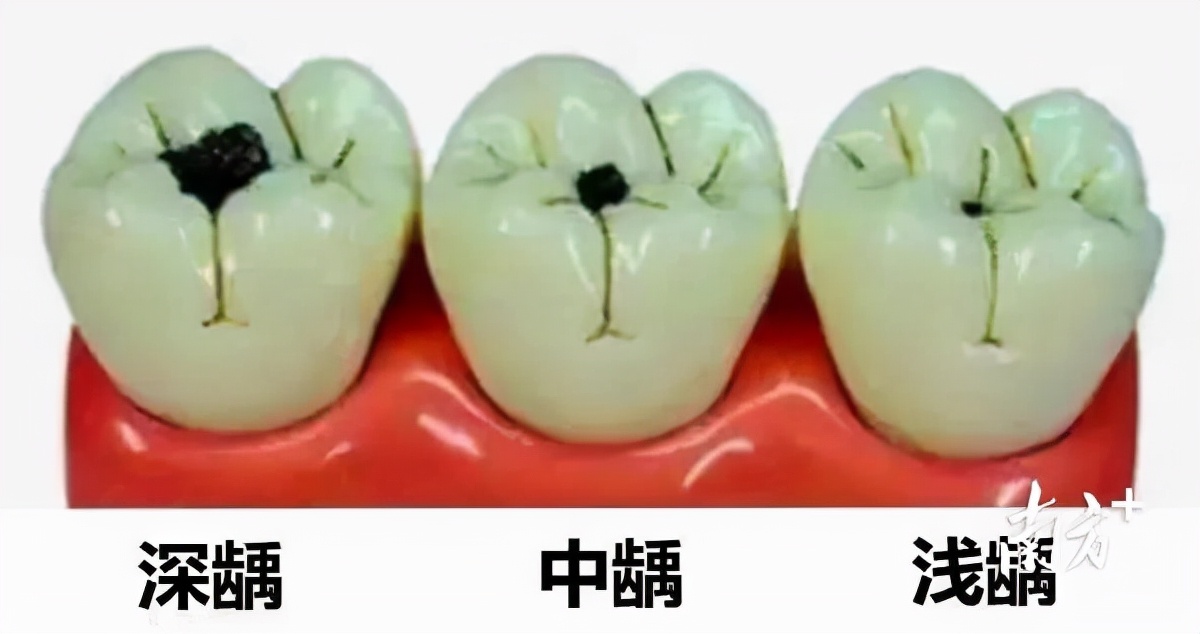 患病率仅次于近视！福田二年级学生可在25家医疗机构免费充填龋齿