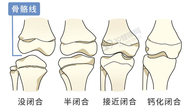 花了家里16万切断双腿骨头，只为增高7.2厘米，如今与后遗症为伴