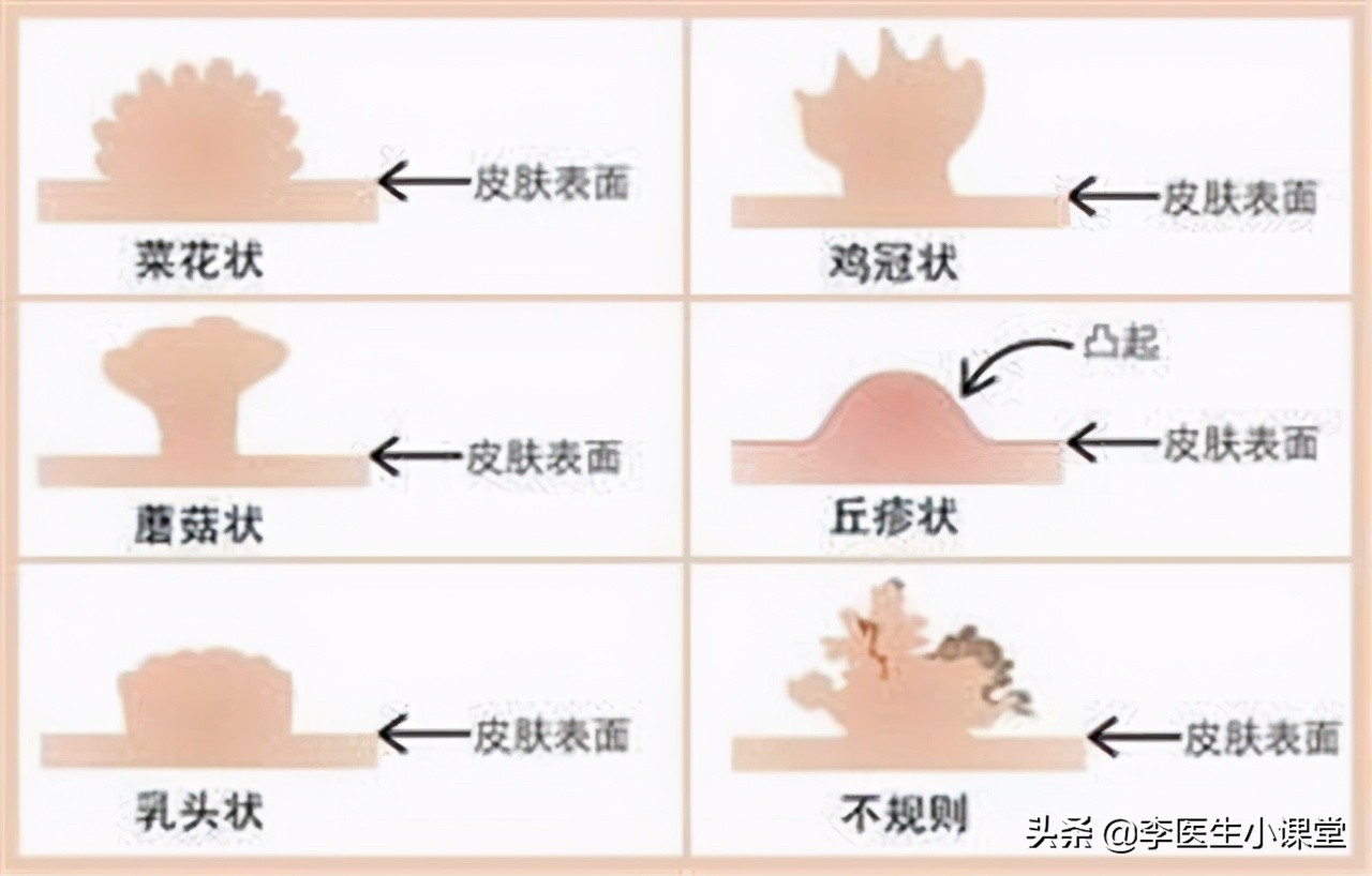“淋病”是什么？如何治疗和预防？