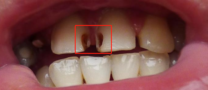 门牙龋齿照片图片
