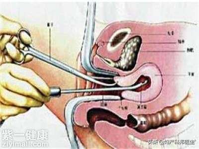 清宫手术过程图解图片
