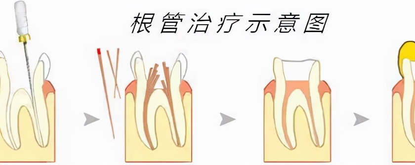 被根管治疗吓哭了！当事人：就是后悔