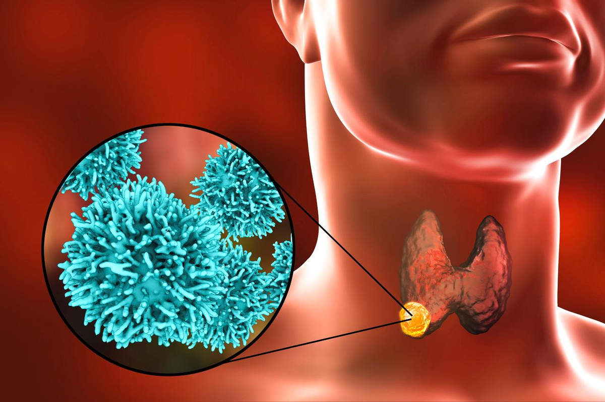 为什么广西甲亢比较多(医生提醒：三种“夫妻癌”盛行，伴侣患癌，你也要赶紧检查一下)