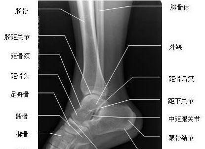 踝关节扭伤后怎么办？需要拍片子吗？要多久恢复？