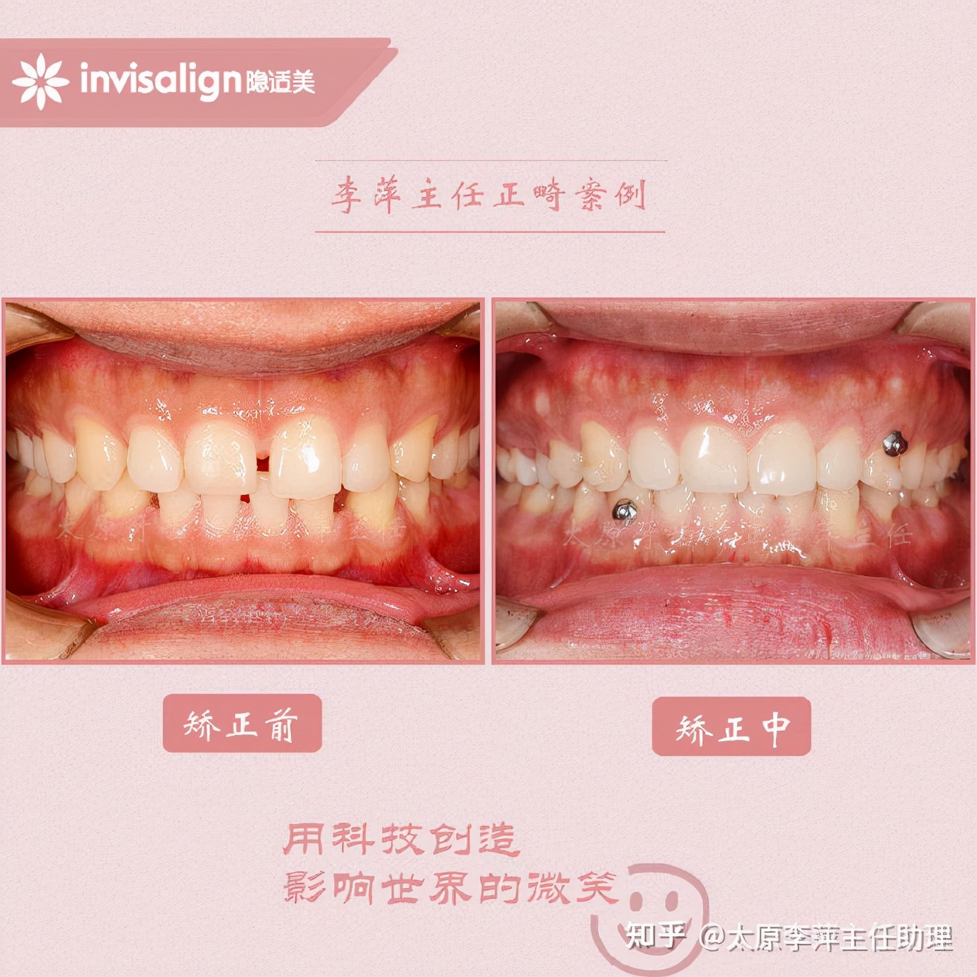 太原牙齿矫正：隐形牙套效果好不好？看这些病例你就知道了