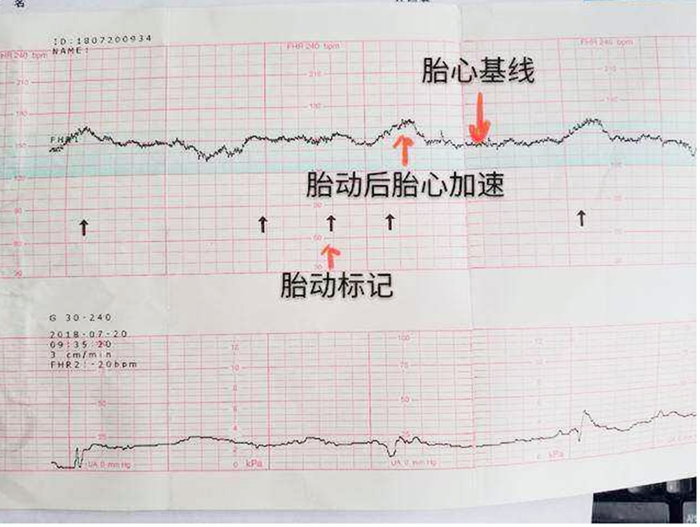 胎心监护图怎么看?这几个数据看懂,自己就能了解胎儿的健康情况