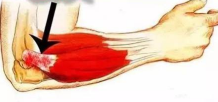 胳膊肘疼不能提重物拧毛巾？骨科医生告诉你有了「网球肘」怎么办