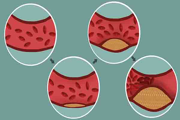 血管堵塞，跟“一酸”吃太多有关，已被世卫组织点名，建议少碰