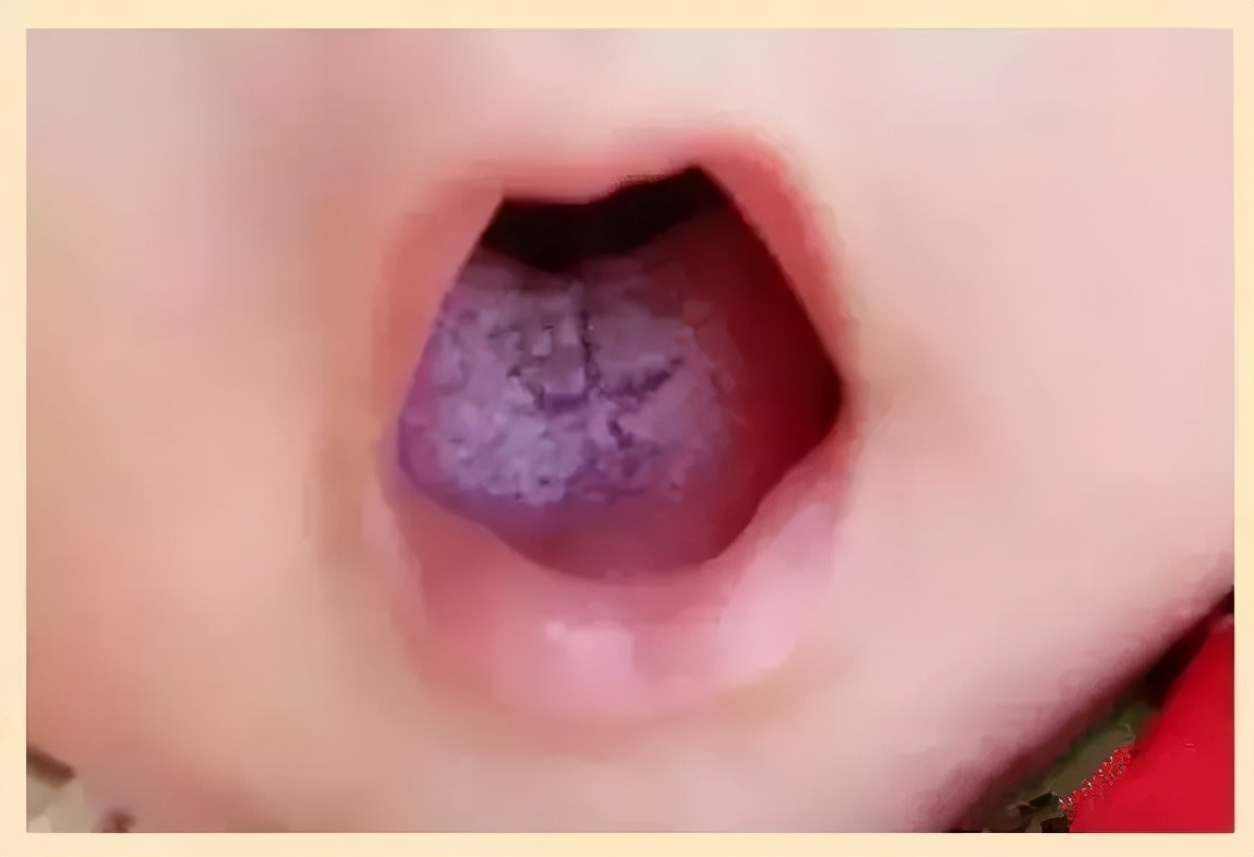 正常婴儿舌系带图片（大西几）-幼儿百科-魔术铺