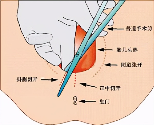 生孩子的撕裂伤口图片(当顺产遇上侧切到底有多痛 赤虎壹号