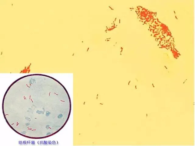 结核感染T细胞检测结果解读与肺结核诊断