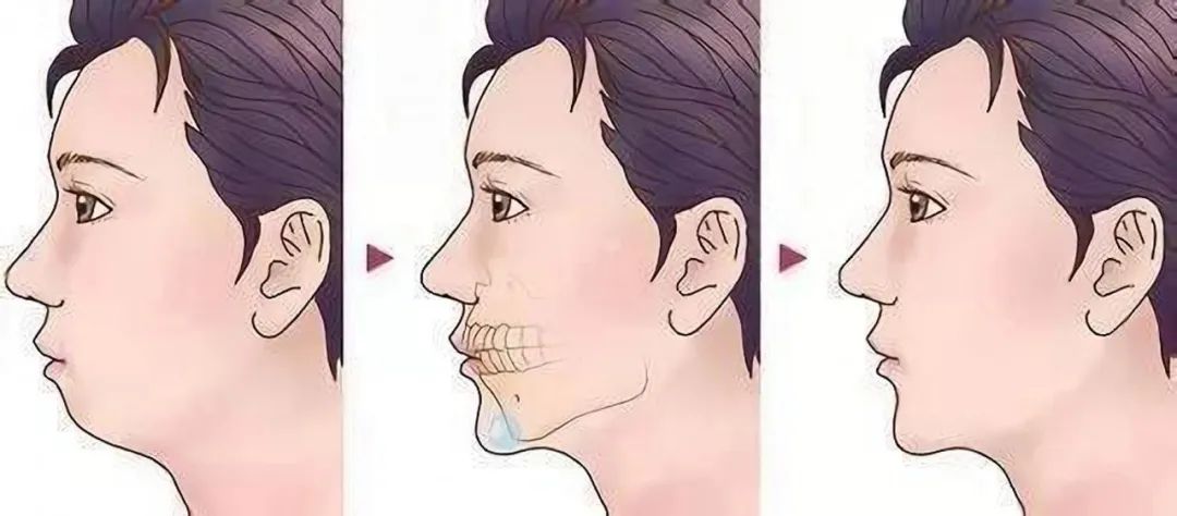 下巴短小与后缩是同一回事吗?又该如何改善?