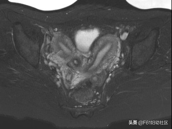 阴道斜隔及图片