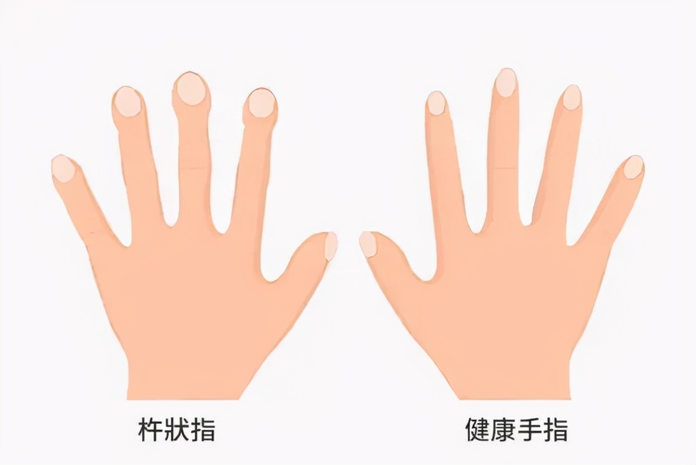 作为疾病较典型体征,杵状指的出现,预警着肺部健康出现问题