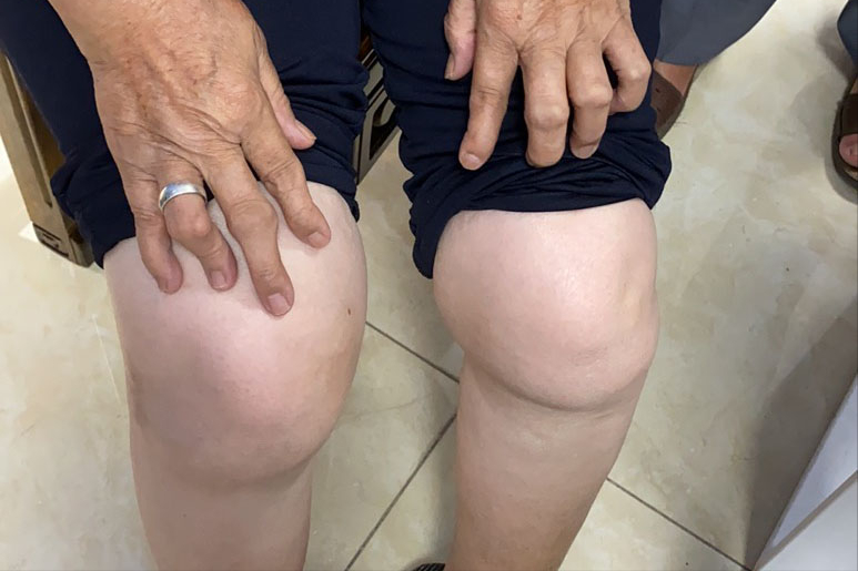 谁更适合类风湿关节炎患者使用?