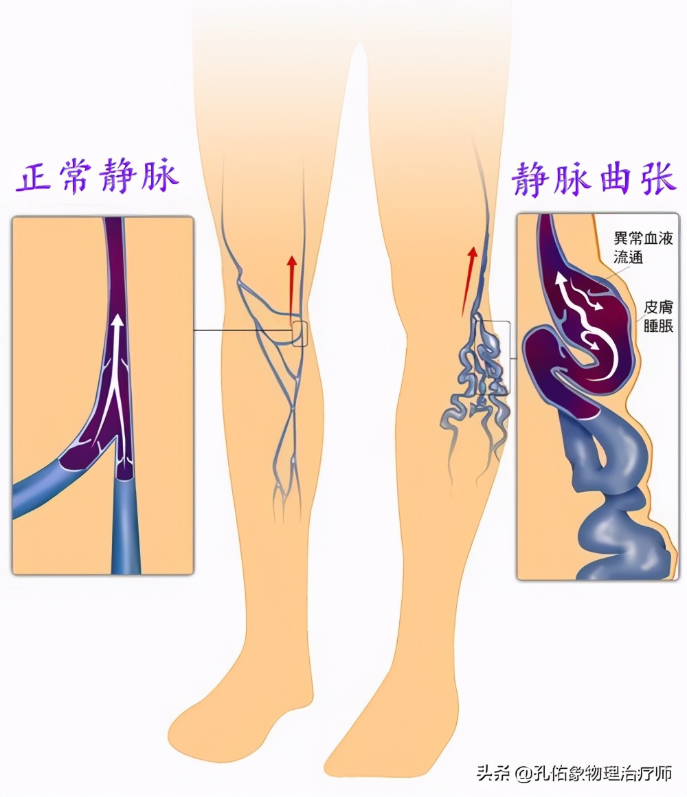 大腿内侧湿疹图片(腿上盘踞的血管像) - 赤虎壹号