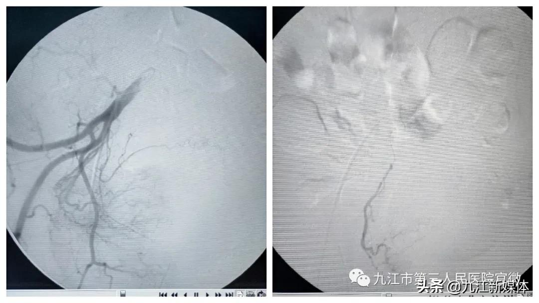 「突破」九江市第三人民医院介入科为膀胱癌并发不可控制出血患者成功实施膀胱动脉栓塞介入手术
