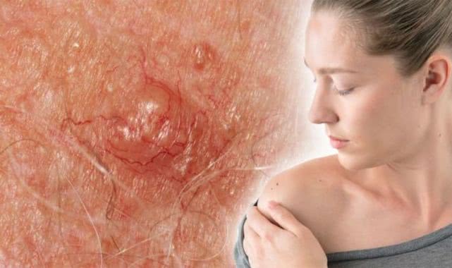 皮肤癌：不论男女，痣出现这5种变化，小心它正在“癌变”