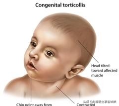 宝宝总是歪头，面向一侧，俗称“歪脖”，听说这叫斜颈，怎么办？