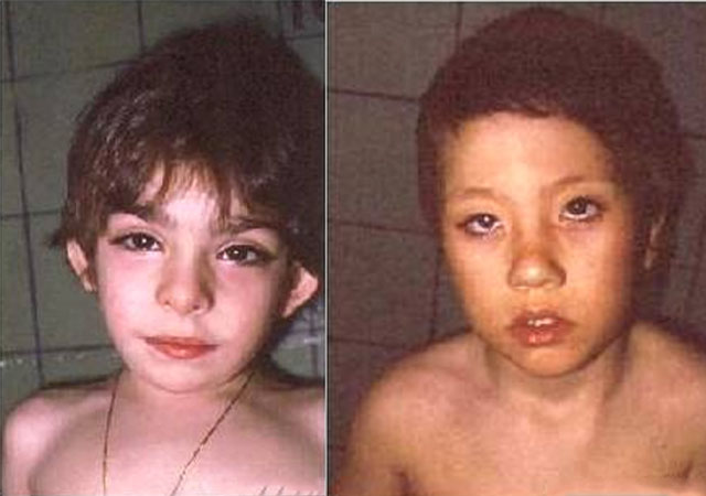 歌舞伎面谱综合征(宝宝太漂亮也是病?