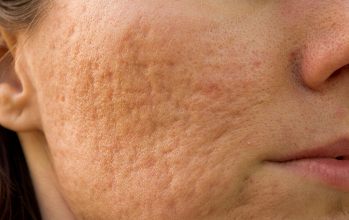 不同类型的痘坑,治疗方案的选择