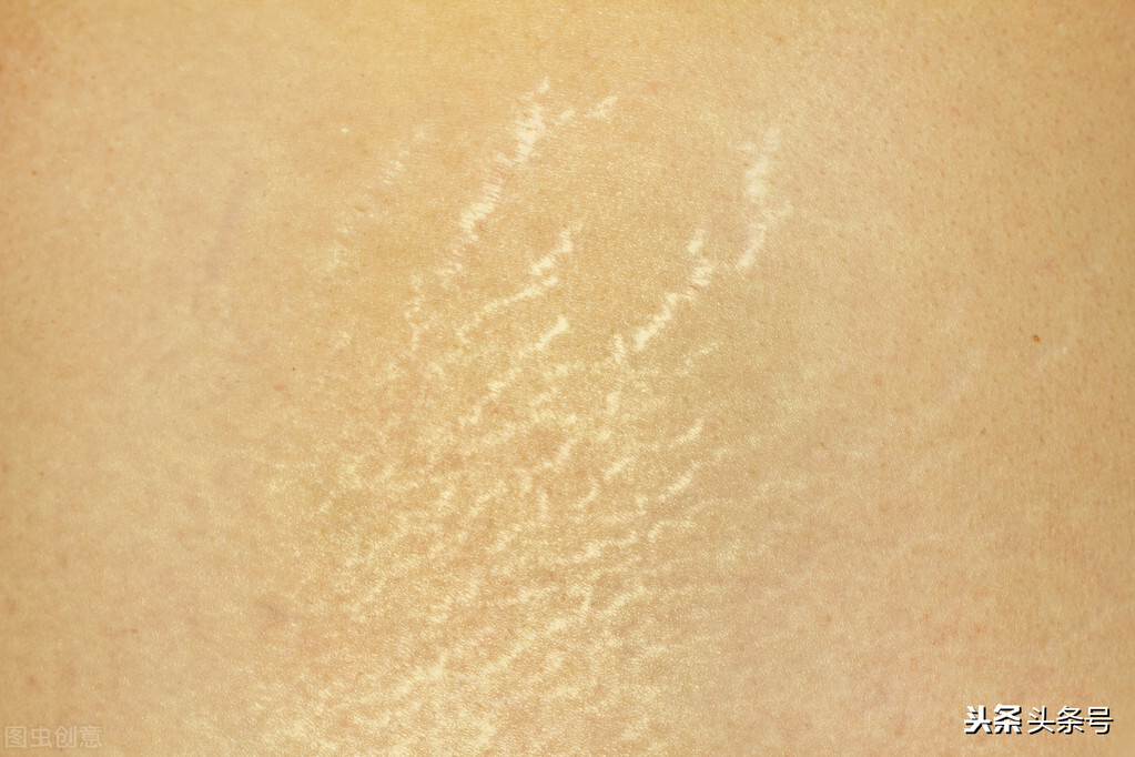 生长纹是什么原因生长纹怎么去掉怎么消除