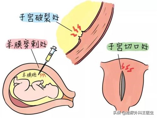 女人切除子宮，对性生活有什么影响呢？