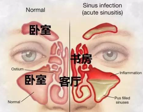 医生提醒：出现这种症状的，不是鼻炎而是鼻窦炎，很可能要做手术