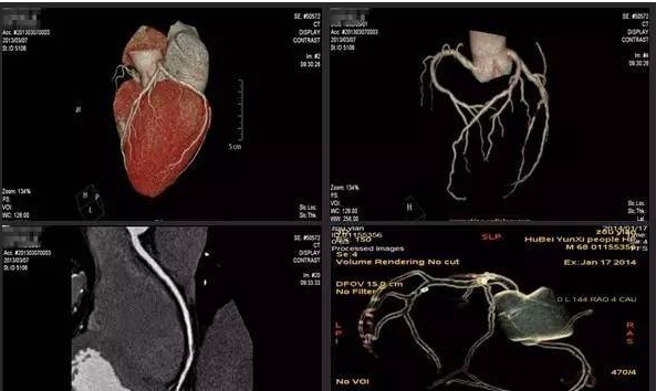 查心脏血管堵塞，4000多的心脏造影和1500的CTA，有啥不一样？