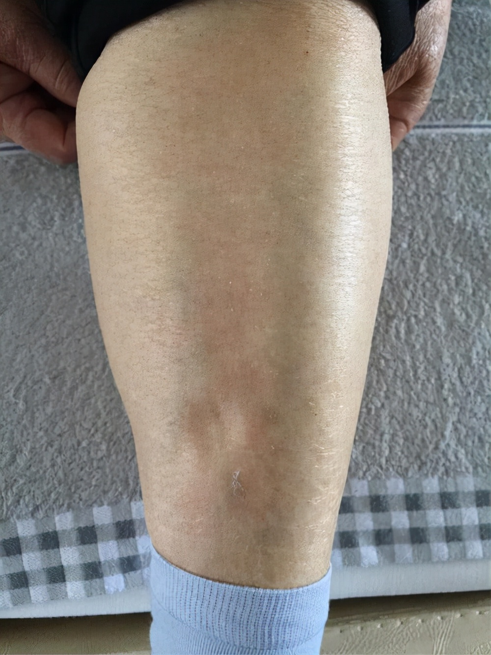 医生提醒:尿毒症多半是拖出来的!出现了4大症状,就要警惕了