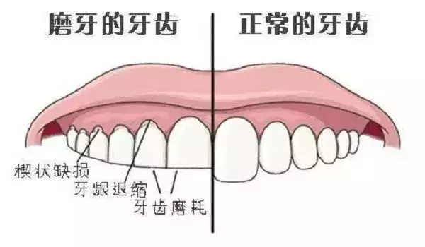“磨牙”是怎么回事?听我来分析分析