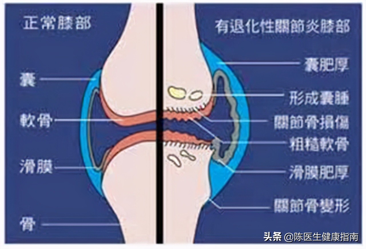 维生素D3、骨化三醇、阿尔法骨化醇，区别在哪里？到底该怎么选？